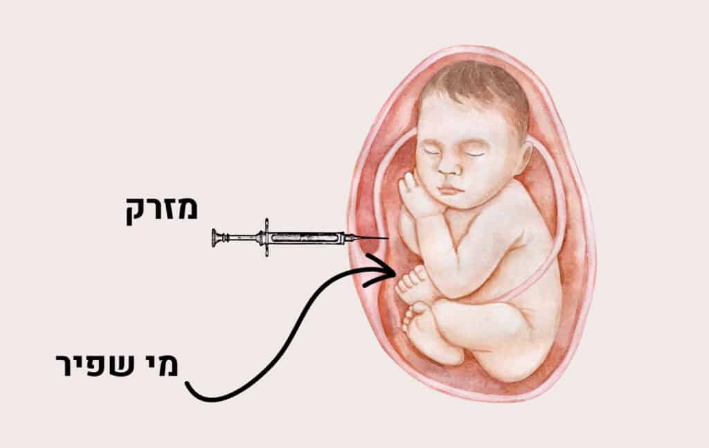 בדיקת מי שפיר בהריון