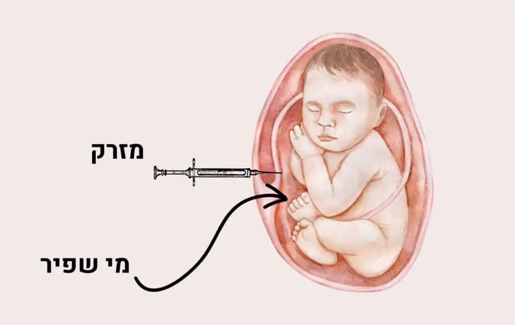 בדיקת מי שפיר בהריון