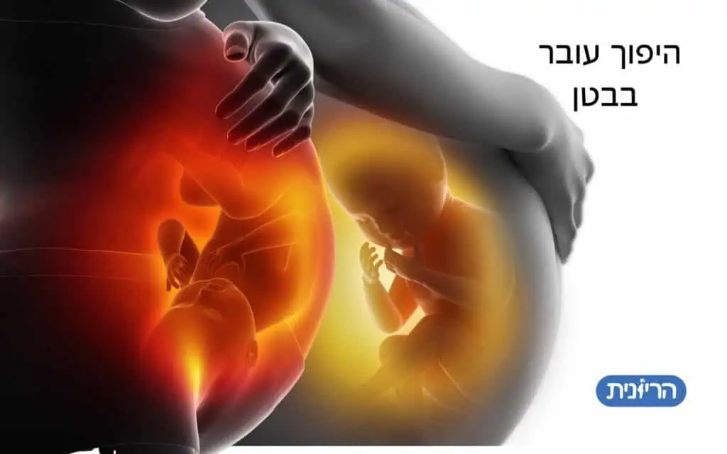 היפוך עובר בבטן