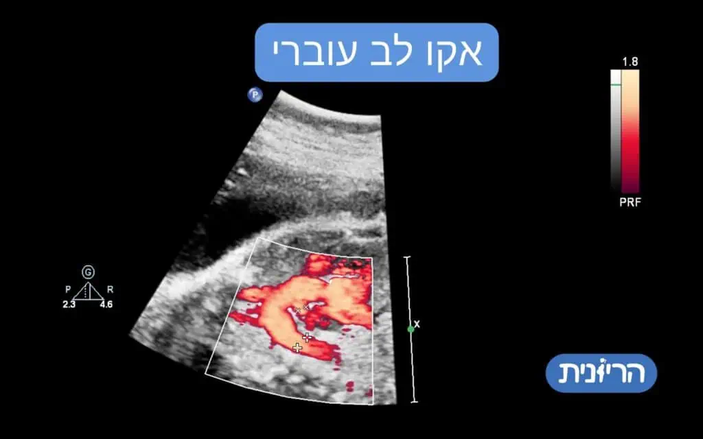 אקו לב עוברי