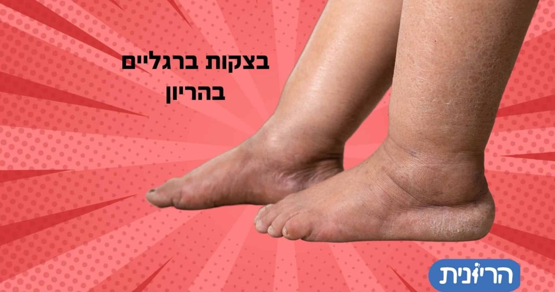 בצקות ברגליים בהריון