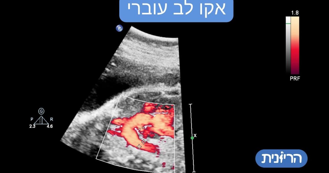 אקו לב עוברי